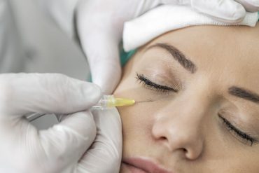 Treatment dark circles eye bags - carboxytherapy Co2