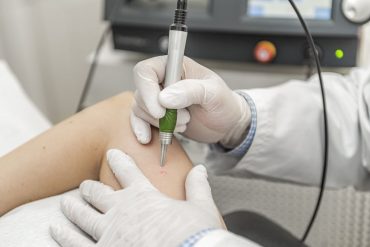 Blood sponge vascular laser veins nose laser xantelasma