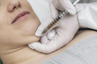 Double chin lipolysis treatment fat pads