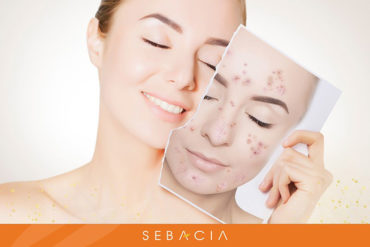 Sebaica acne treatment