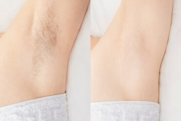 Long-lasting hair reduction with laser » derma competence center