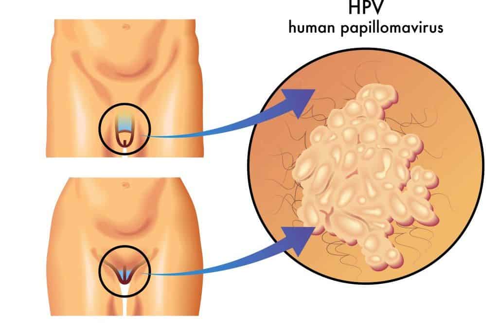 Emberi papillomavírus warzen. A HPV-fertőzés előfordulása