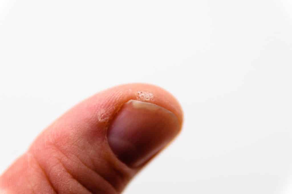 Warze unterm fingernagel entfernen