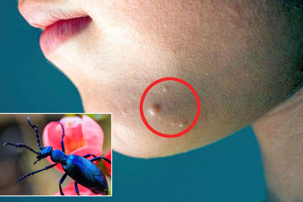Blister beetle extract naturally helps against mollusc warts - new therapy for mollusc warts