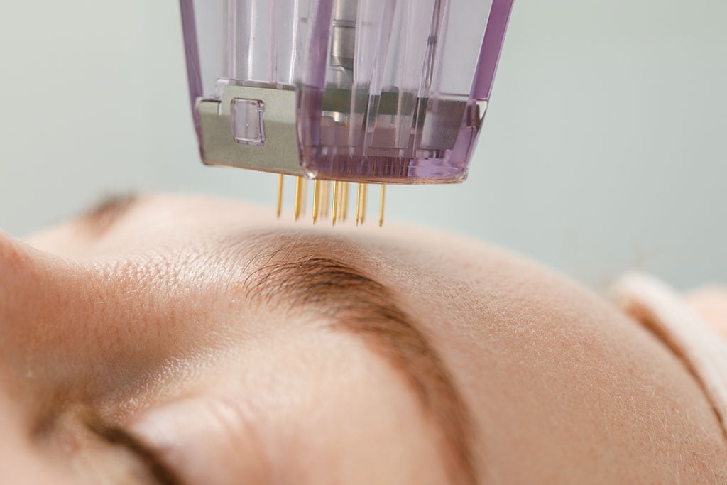 Radiofrequency needling for acne treatment and skin texture improvement